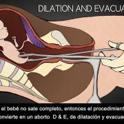 Aborto Inducido en el Tercer Trimestre